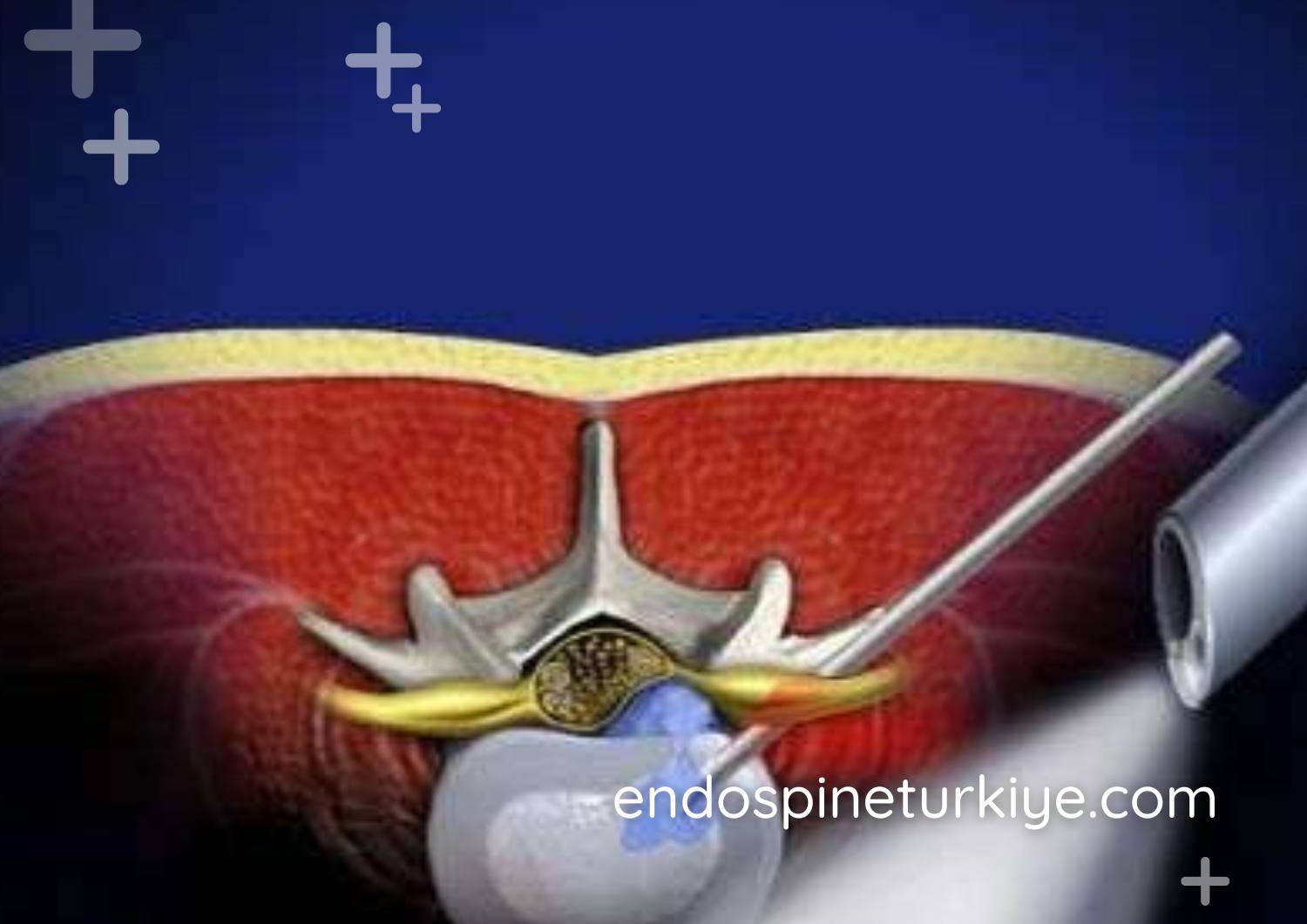 Belde dar kanal ameliyatı - lomber spinal stenoz tedavisi