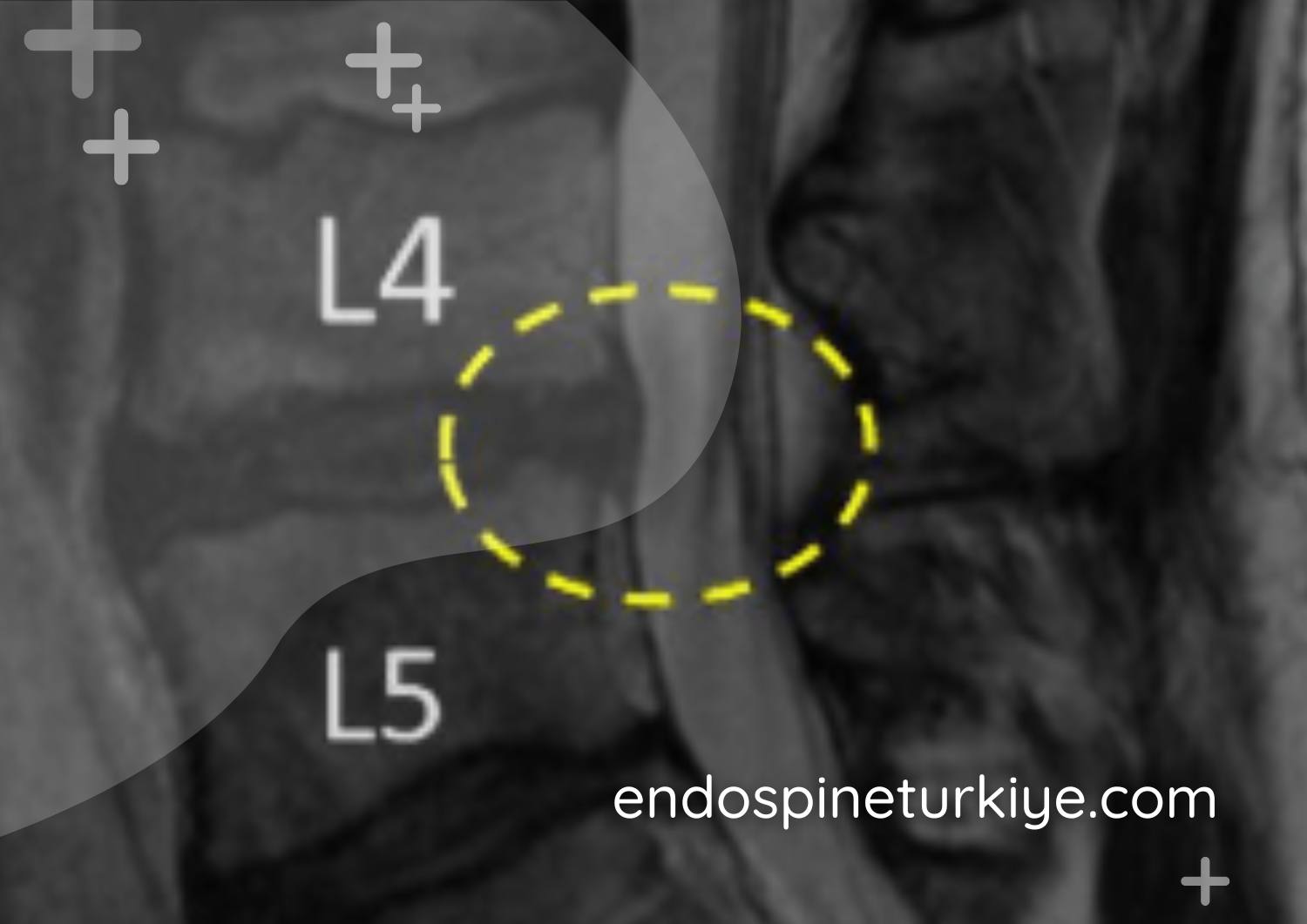 Dar kanal ameliyatı sonrası MR - dekompresyon sonucu
