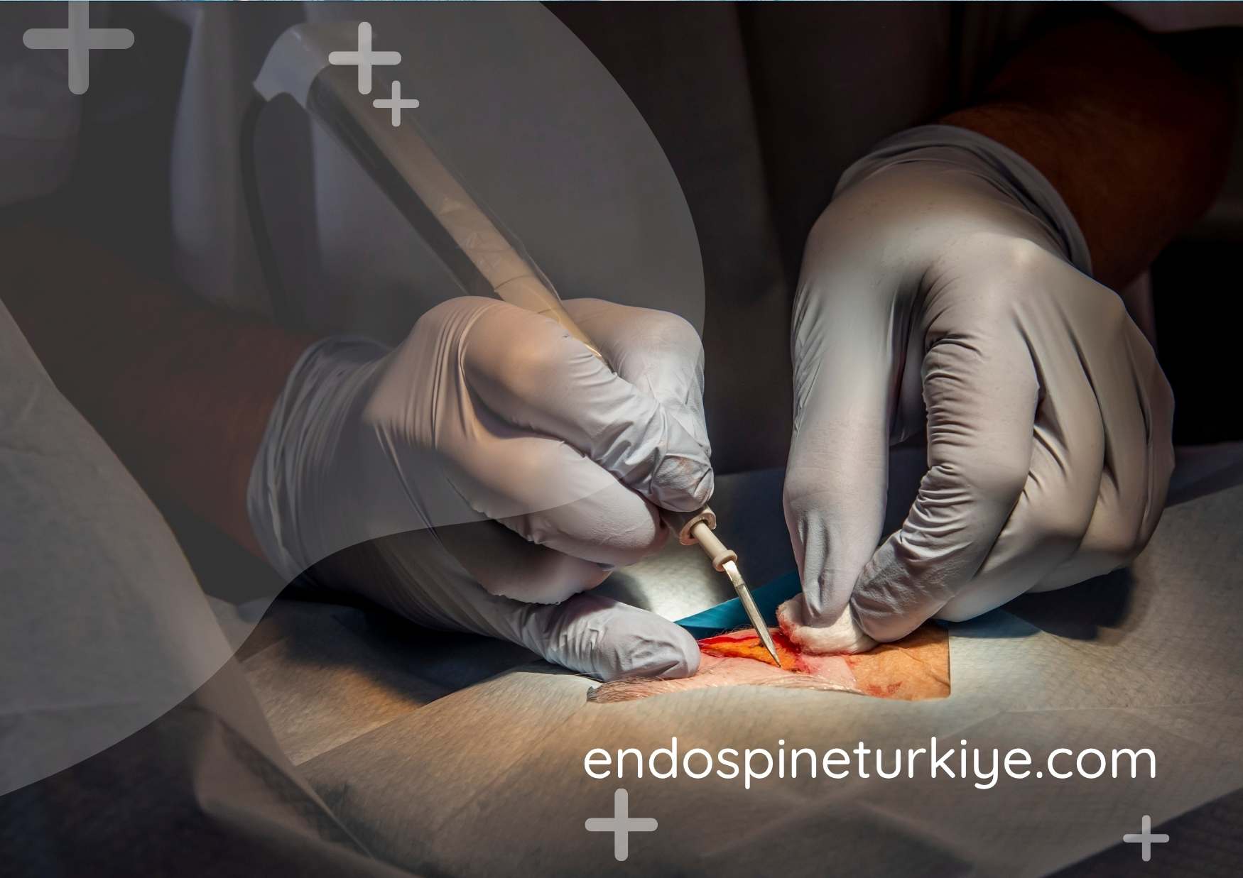 Tam kapalı endoskopik omurga cerrahisi - Op. Dr. Rifat Saygın Altınağ ile 6mm kesi ile ameliyat