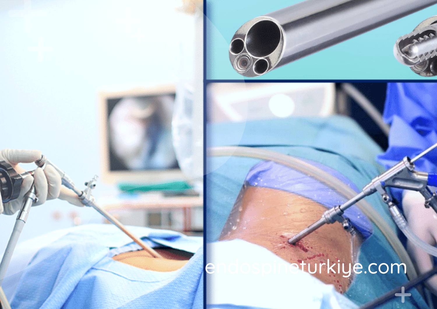 Tam kapalı endoskopik bel fıtığı ameliyatı - 6mm kesi ile günübirlik tedavi